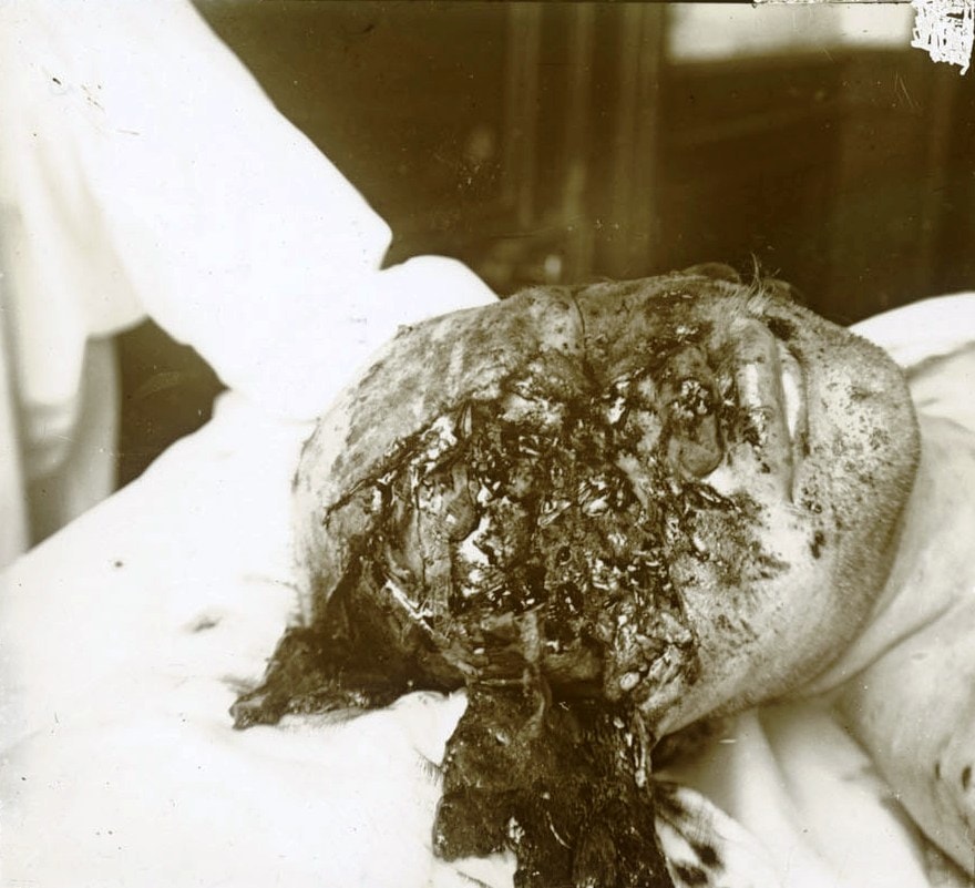 « Gueule cassée » (nom donné après la guerre aux soldats mutilés de la face). Collection de plaques de verre stéréoscopiques de Maurice Brun, 89e RI. Sans date. Archives nationales, 700AP/14/PA_341/1